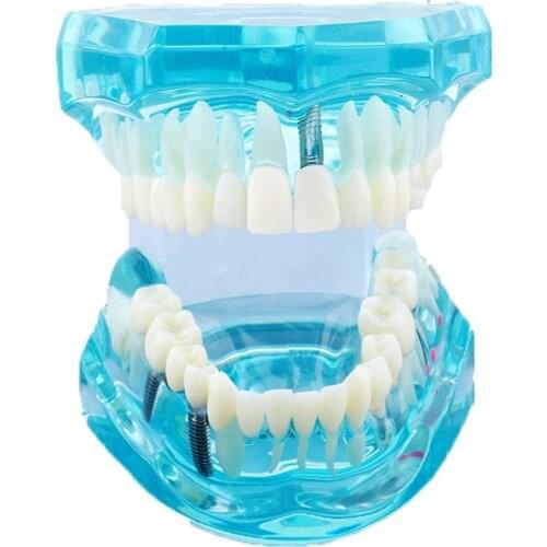 Implant Disease Teeth Model With Restoration Bridge crown Dental Study Tooth Implant Pathological Teeth model