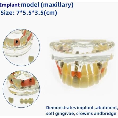 Clear Transparent Dental Implant Teeth Bridge Model Typodont Lower Jaw 2010