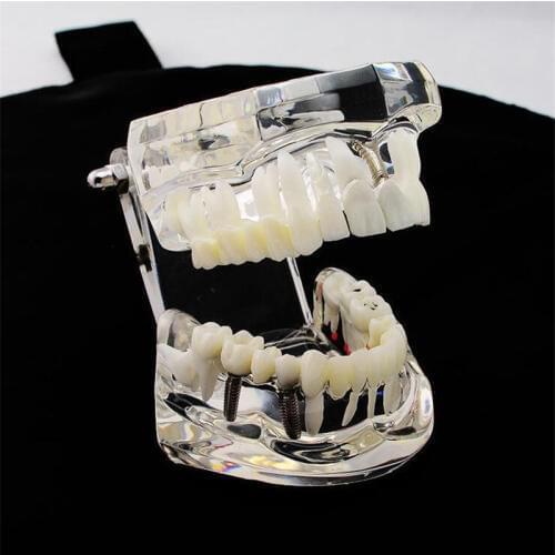 1 Pcs Dental Implant Tooth Model Showing Restoration Bridge Medical Science Dentist Teaching Study