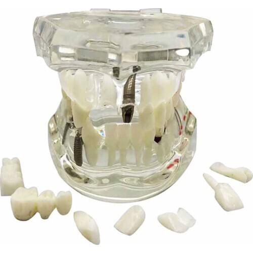 Dental Restoration Teeth Model Transparent Implant Disease Teeth Model with Bridge Detachable Teeth Disease Teaching Study Model