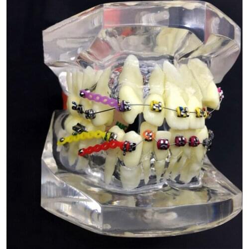 Orthodontic Malocclusion Correction Model With Bracket Ligature Wire Dental Standard Correction Teeth Model Display