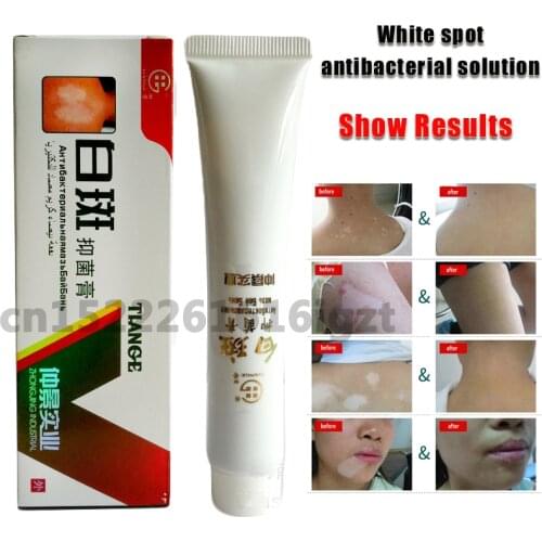 Chinese Medical White Spot Disease Cream Pigment Melanin Promoting Liniment Skin Vitiligo Leukoplakia Disease Treatment 30g