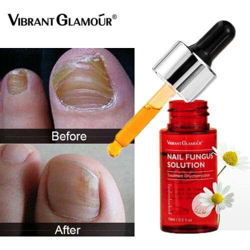 VIBRANT GLAMOUR Nail Repair Essence Fungal Nail Treatment Serum Remove Onychomycosis Paronychia Anti Infection Fungal Nail Care