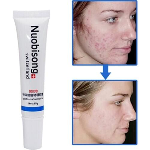 2pc Nuobisong no box treatment the face Pimples scar Stretch Marks removal acne treatment whitening moisturizing cream