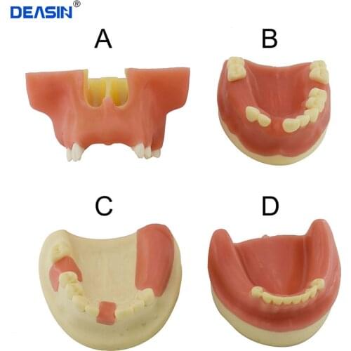 1 pc Dental Teeth Planting Practice Model Lower Jaw Implant Model With Soft Gum Dentist For Medical Dental Education