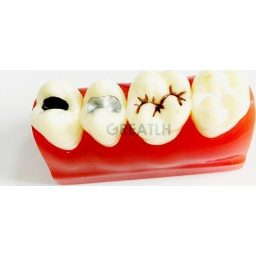 Dental Pit and Fissure Sealing Treatment Teeth Tooth Study Learn Model