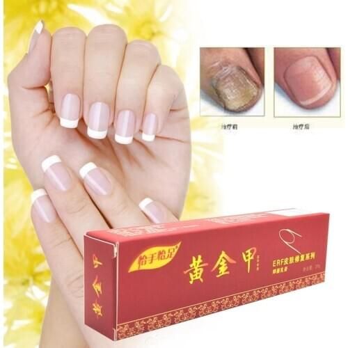 Nail Fungus Treatment / Onychomycosis Paronychia / Anti Fungal Nail Infection Good Result Chinese Herbal Toe Nail Treatment