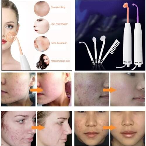 Handheld 4 in 1 Skin Tightening Facial Machine Acne Spot Wrinkles Remover