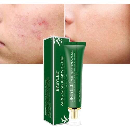 BREYLEE Acne Scar Removal Gel Essence Fade Acne Marks Spots Remove Skin Pigmentation Whiten Moisturizing Oil Control Face Serum