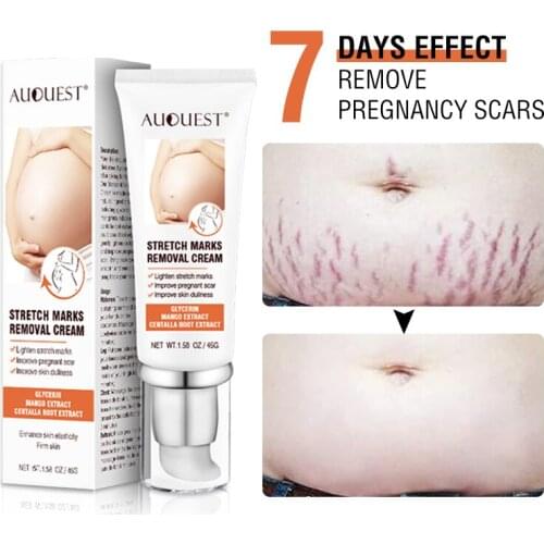 Remove Pregnancy Scars Acne Cream Stretch Mark Treatment Maternity Repair Anti-Aging Anti-Winkle Firming Body Cream 45g