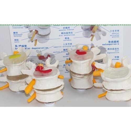 4 pcs Lumbar spine pathology model lumbar vertebra model spine vertebral disc herniation