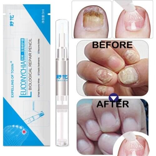 1pcs Anti Fungal Onychomycosis Paronychia Nail Pen Liquid Nail Growth Nail Healthy Care Tools Medicinal Liquid Nail Treatments