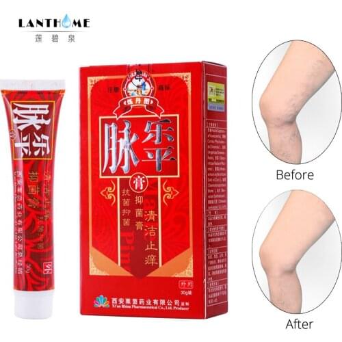Varicose Veins Treatment Cream Ointment Vasculitis Phlebitis Spider Veins Pain Varicosity Angiitis Remedy Removal Herbal Cream