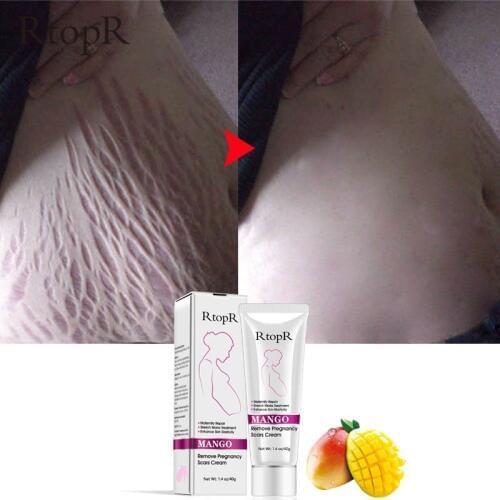 RtopR Natural Mild Non-irritating Mango Stretch Mark Cream For Pregnancy Repair Scar Slack Line Abdomen Stretch Marks Cream