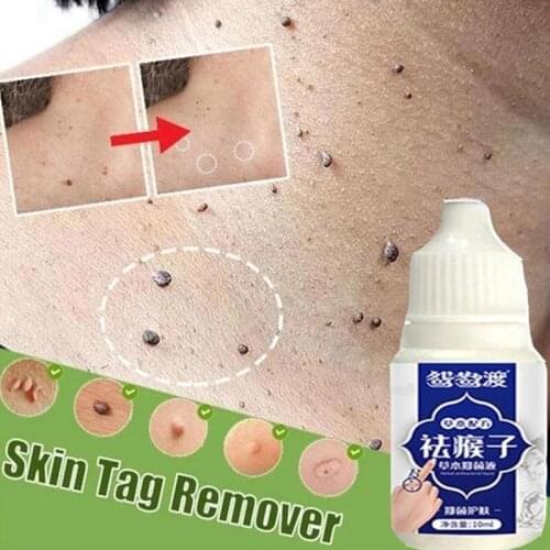 10ml Skin Tag Remover Genital Wart Removal Against Mole Body Warts Treatment Foot Corn Removal Skin Tag Remover Foot Care