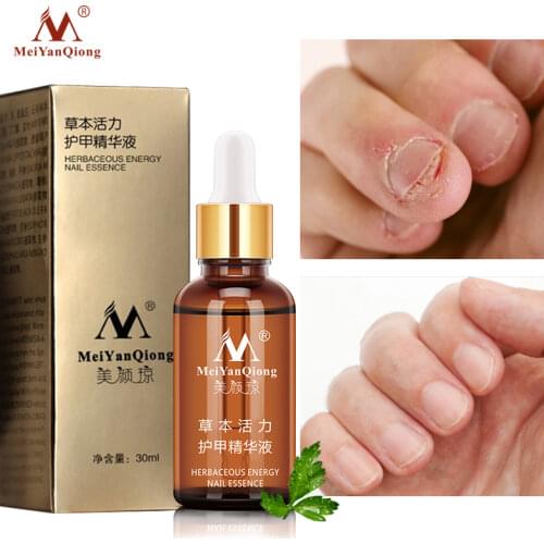 Fungal Nail Treatment Feet Care Essence Nail Foot Whitening Toe Anti Infection Paronychia Onychomycosis Nail Fungus Removal Gel