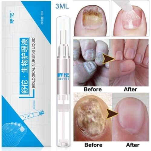 Onychomycosis Paronychia Anti Fungal Nail Liquid 3ML Fungal Nail Treatment Pen