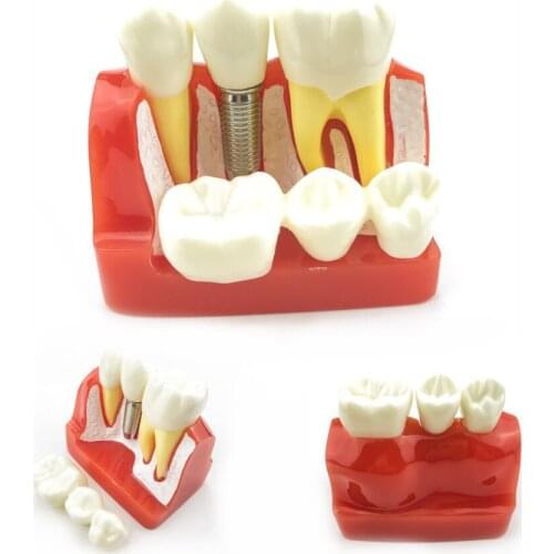 Dental Teach Implant Analysis Crown Bridge Removable Model Oral Education Teeth Model#2017 Dentist Equipment