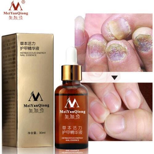 MeiYanQiong Remedies For Nail Fungus