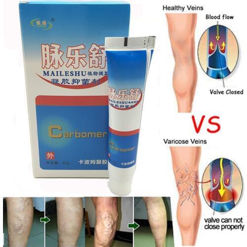 1PC Varicose Veins Cream Of Varicose Veins Medical Spider Veins Treatment Chinese Medicine Varicose Veins Ointment
