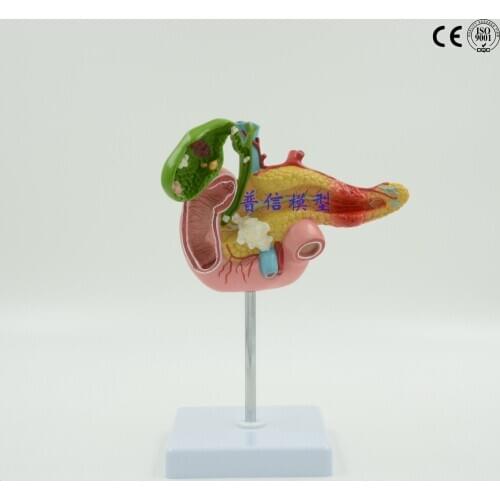 Free shipping& pathological model of pancreas, duodenum and gallbladder, and the model of gallstone and digestive system, liver