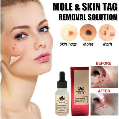 Mole & Skin Tag Removal Solution Painless Mole Skin Dark Spot Removal Face Wart Tag Freckle Removal Cream Oil Plaster
