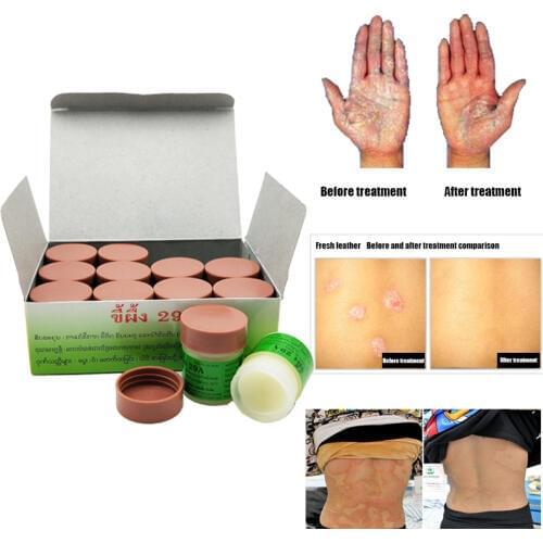 3pcs Profesprofessional Cure Psoriasis Ointment Original From Vietnam Native Medicine Ingredient Security