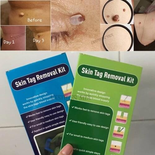 Skin Tag Removal Kit Papilloma Removal Skin Cleansing Kit 4-6mm Tag Treatment For Removes Berrugas In Skin Wart Mole Remover
