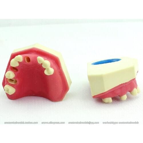 CMAM/12611 Dental- Implantation of missing teeth, Human Oral Dental Medical Teaching Anatomical Model
