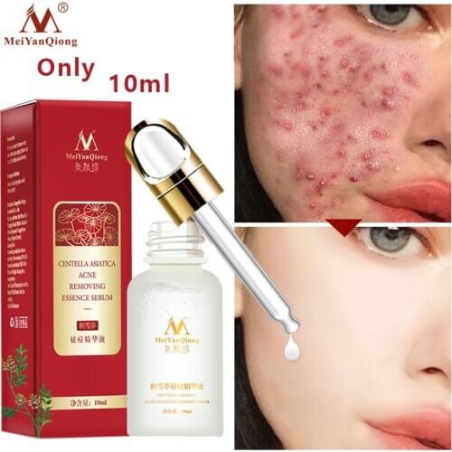 Acne Treatment Face Serum Centella Asiatica Oil Control Shrink Pores Scar Essence Whitening Moisturizer Skin Care MeiYanQiong