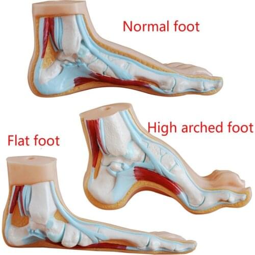 Medical Anatomy Human Foot Normal Foot Flat and Arched Foot Anatomy Model Human Sketelon Model Flat Feet High Arched Feet Model