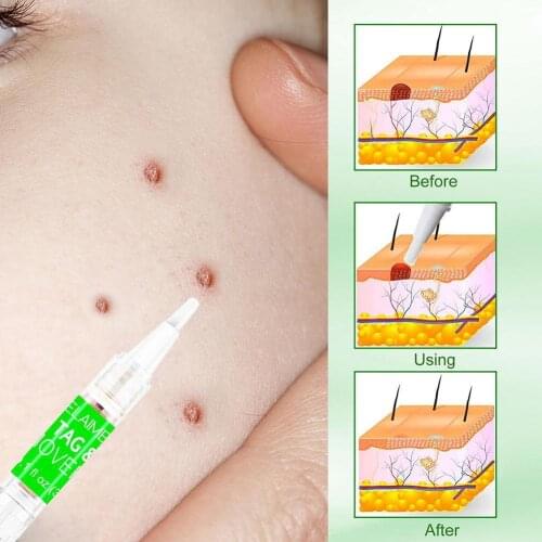 Wart Removal Pen Corn Meat Thorns Wart Sticks Fading Mole Spot Reducing 36 Plaster Body Warts Tag Skin Pieces Marks I4N4