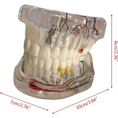 Dental Disease Implant Teeth Model with Restoration Bridge Tooth Dentist for Medical Science Disease Teaching Study