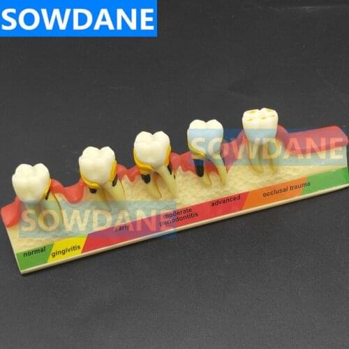 Dental Teeth Model Periodontal Disease Assort Tooth Classification Model Typodont