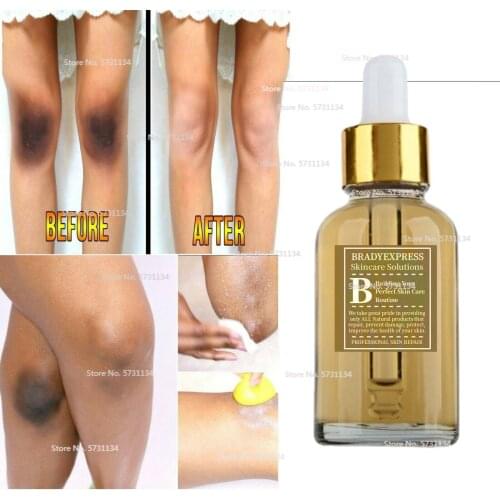 DARK KNEES AND ELBOWS LIGHTENING Serum, Dark Spots Cream Body Oil