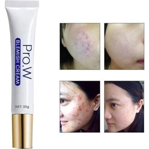 30g Acne Treatment Blackhead Remova Anti Acne Cream Oil Control Shrink Pores Acne Scar Remove Face Care Whitening Hot Selling