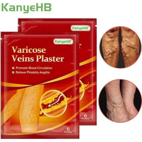 12pcs Varicose Veins Patch Vasculitis Phlebitis Spider Cream Varicosity Angiitis Removal Phlebitis Leg Veins Pain Plaster A593