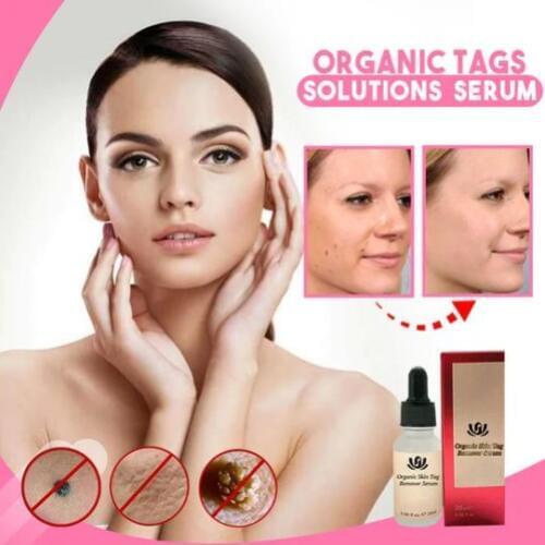 Organic Tags Solutions Serum Painless Mole Skin Dark Spot Remover Serum Face Wart Tag Freckle Removal Cream