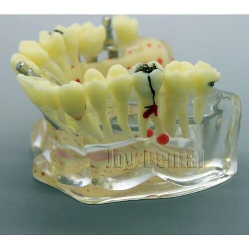 Human model Dental implant model Pathological show Oral dental comprehensive teaching models free shipping