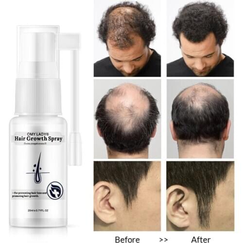 OMY LADY Anti Hair Loss Hair Growth Spray Essential Oil Liquid For Men Women Dry Hair Regeneration Repair,Hair Loss Products