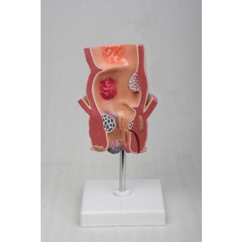5 Times Human Anatomy Rectal Hemorrhoids Lesion Model Internal Hemorrhoids Anal Model Anatomy