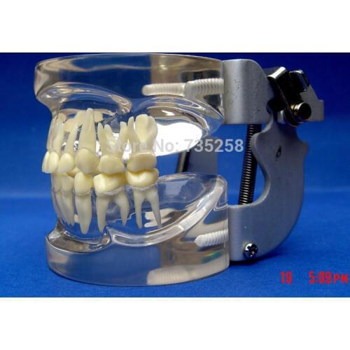 Senior Baby Teeth Tooth Column Model,Transparent Crystal Baby Teeth Model,Childrens Teeth Model