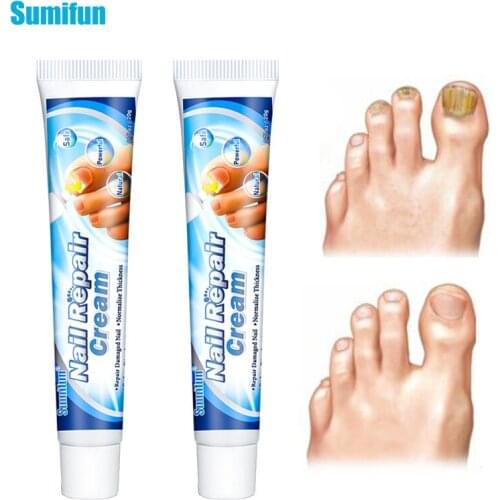 Sumifun 20g Fungal Nail Repair Cream Finger Toe Onychomycosis Treatment Anti Fungus Infection Ointment