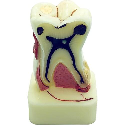 Teeth Model 4 Times Pathologies Model Dental Model Disease Dentist Dental Educational Equipment