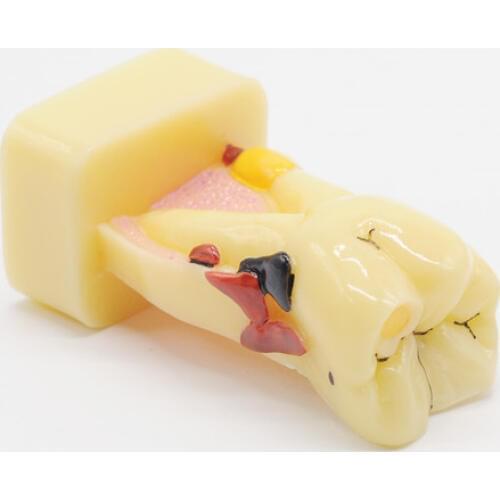Study Teach Tooth Model Teeth Disease Model For Dental Lab Equipment
