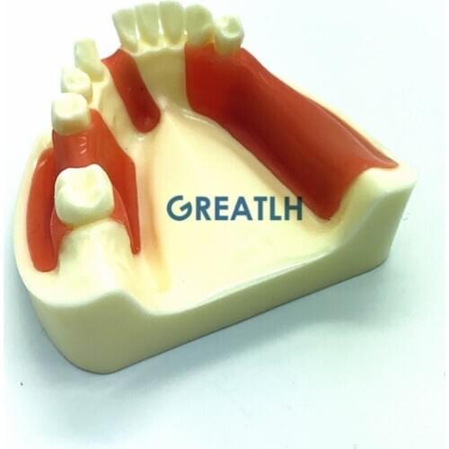 Dental Lower Jaw Implant Practice model Gingiva with missing teeth dentist educational dental school teeth practise model