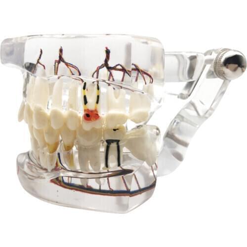 Dental Consumable Teeth Model Medical Studying Implant Disease With Restoration Bridge Tooth Dental Teaching Model