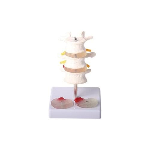 Refined pathological model of 3-segment lumbar spine with 4-segment intervertebral disc