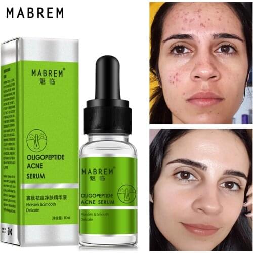 MABREM Acne Treatment Serum Oligopeptide Deep Cleaning Shrink Pores Repair Hyaluronic Acid Moisturizing Nourishing Face Essence