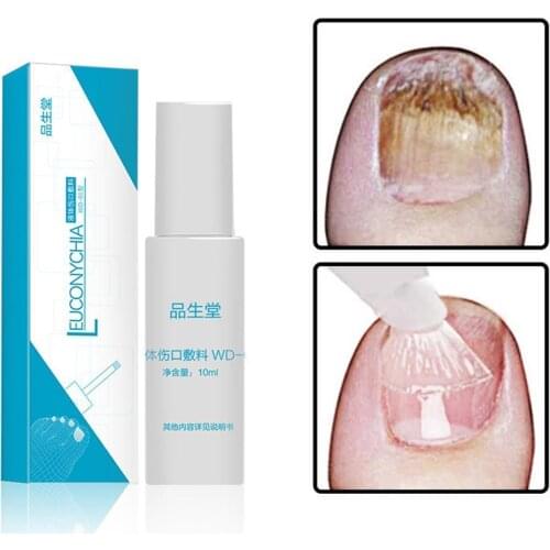 10ml Nail Treatment Pen Nail Care Solution Anti Fungal Nail Anti Repair Liquid Tool Nail Fungus Nail Care Liquid S4O8